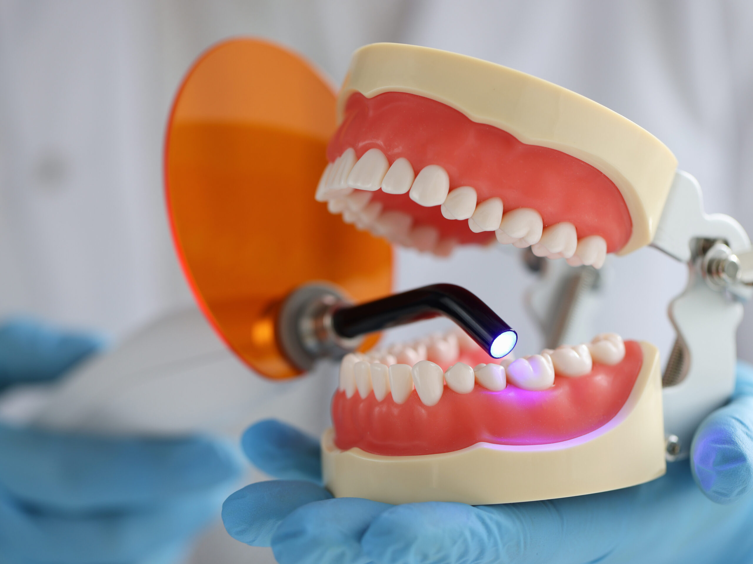 Zahnfüllung wird mit UV-Licht ausgehärtet