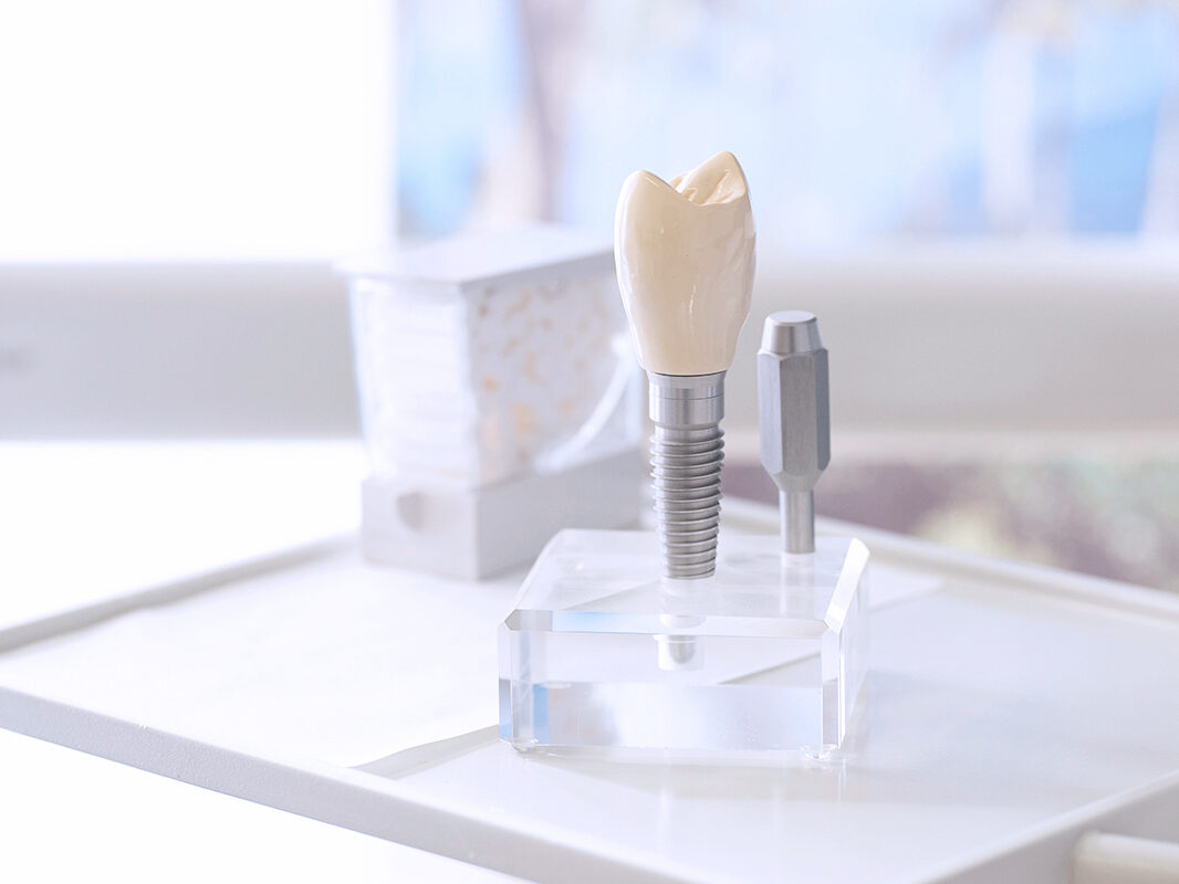 Modell eines Zahnimplantats zur Rekonstruktion