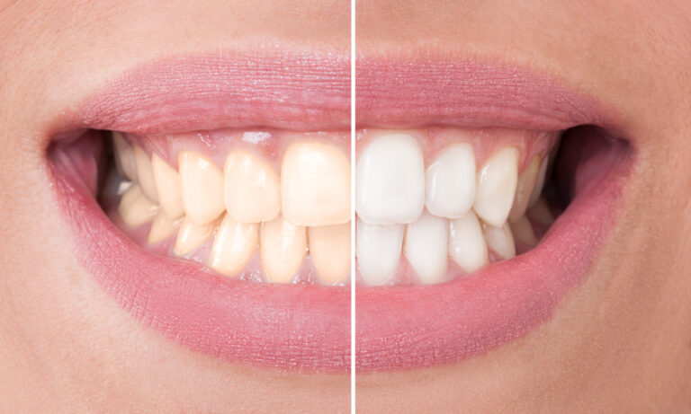 zahnbleaching-vorher-nachher Vorher-Nachher-Bild eines Gebisses mit gelblicheren und aufgehellten Zähnen nach dem Zahnbleaching