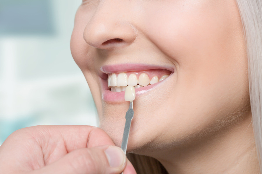 veneers-aesthetische-zahnkorrektur-ulm Veneerschale wird an die Zähne einer Patientin gehalten